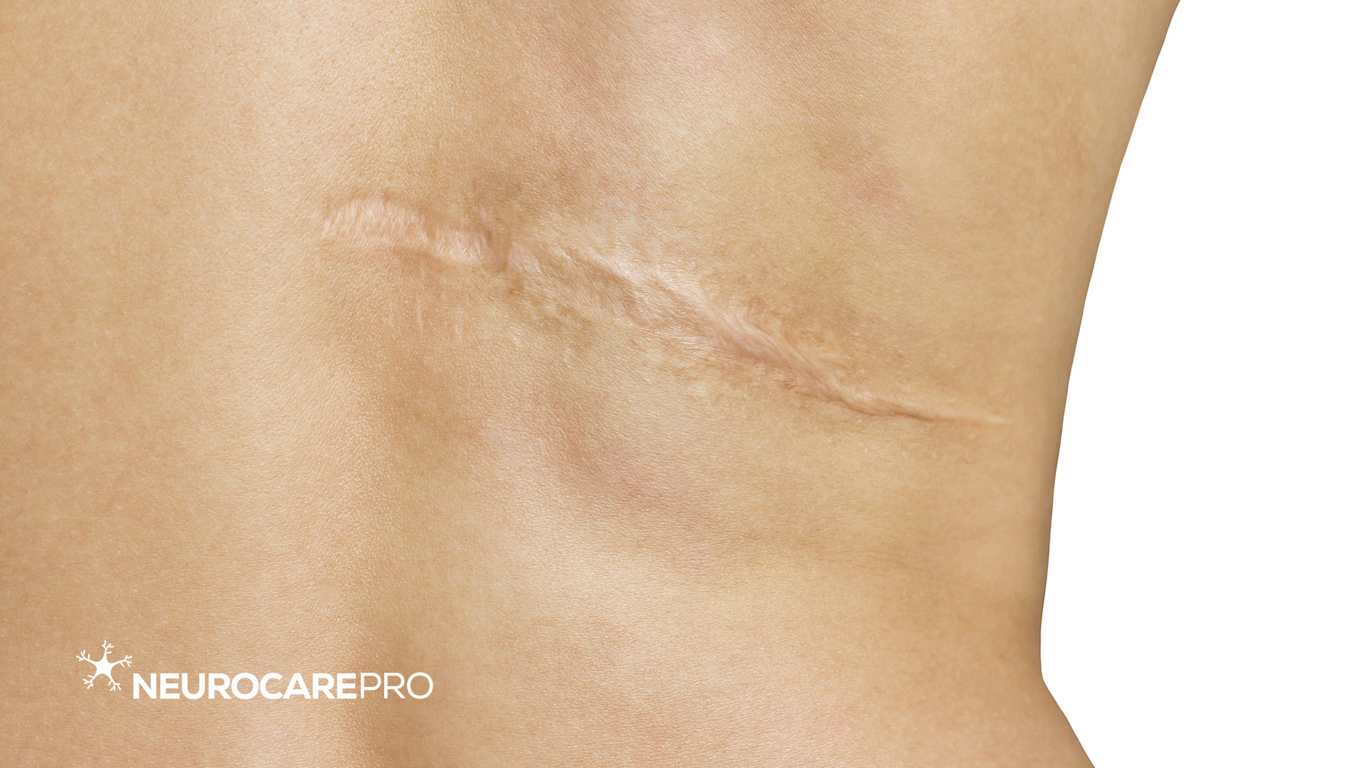 scar removal red light therapy - Treat Scars with Red Light Therapy