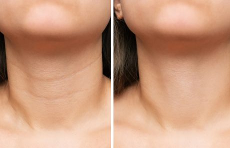Neck-Wrinkles-Removal