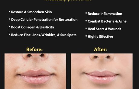 Before and After of Red Light LED MASK usage. It definitely works.