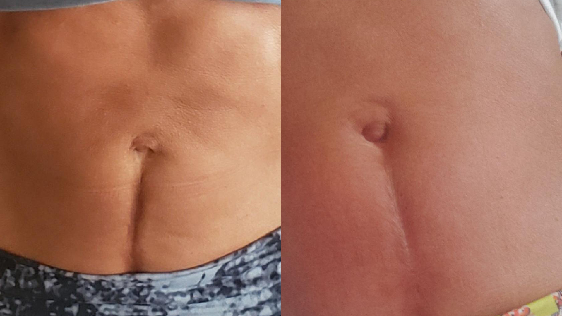 Before and After picture of red light therapy on tummy