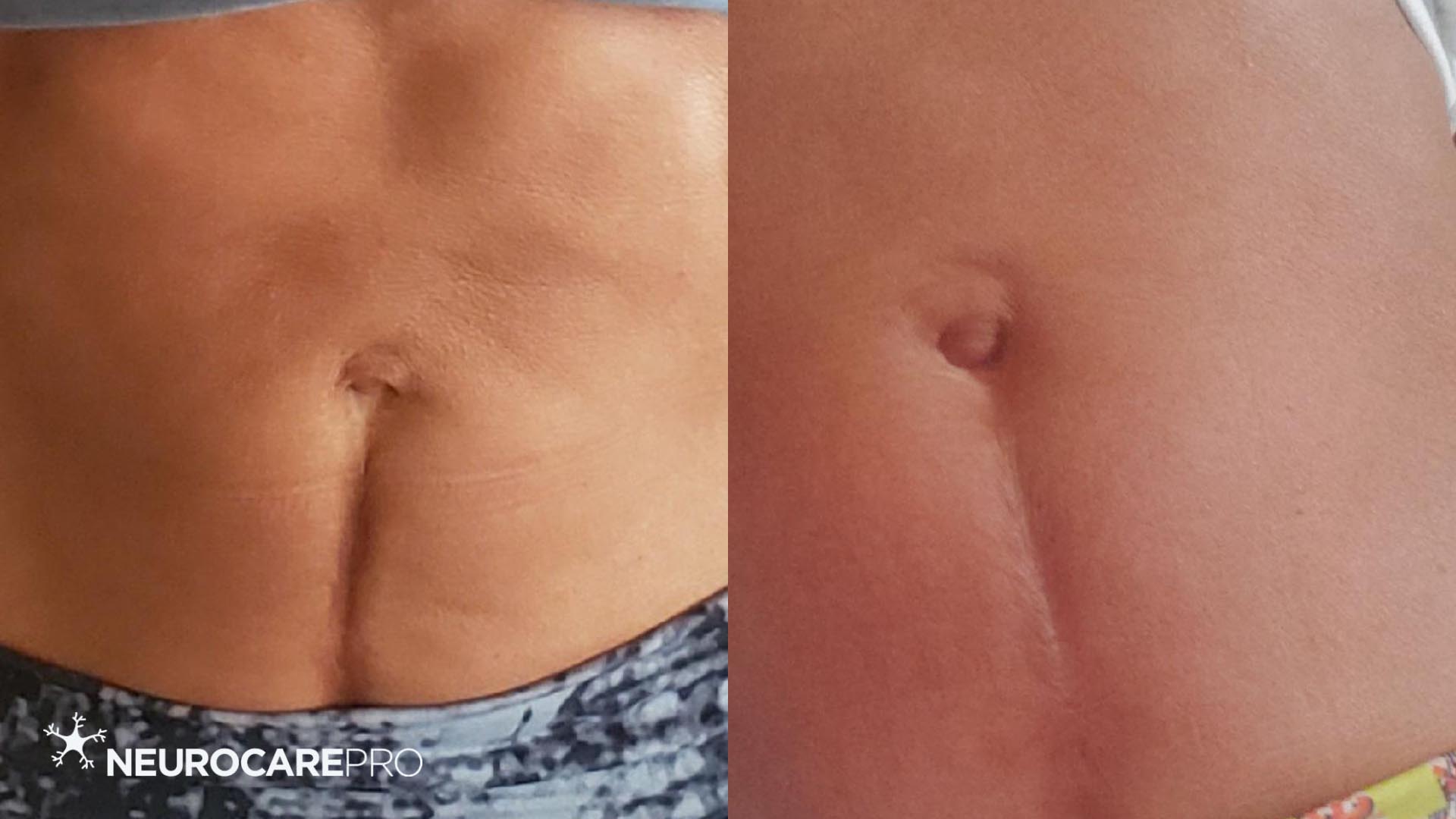 COMPARE SKIN SCARS AND OTHER TREATMENTS WITH PULSED LIGHT MEDICAL TECHNOLOGY BY NEUROCARE PRO