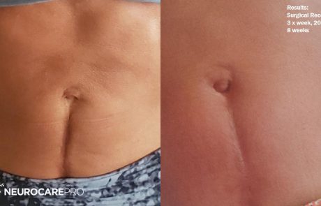 SurgicalRecovery_Before&After-picture-of-PLMT-abdominal
