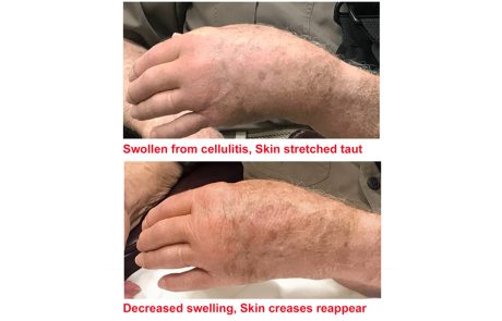 cellulitis-PLmT_before_after_2_sessions